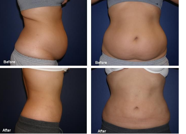 Quick Tone Refresh - Cryo & RF Treatment