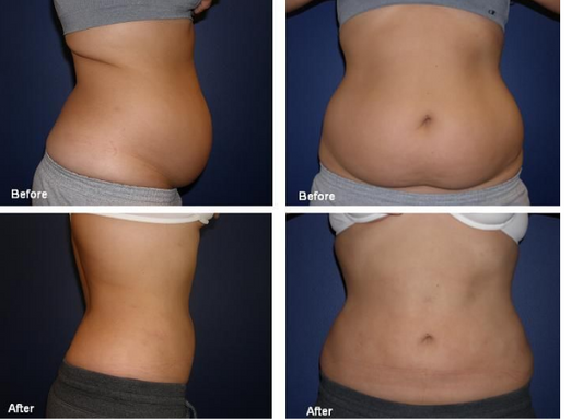 Quick Tone Refresh - Cryo & RF Treatment